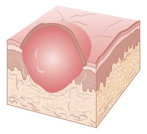 <p>vesicle with white cellular debris, may be infected or sterile</p>
