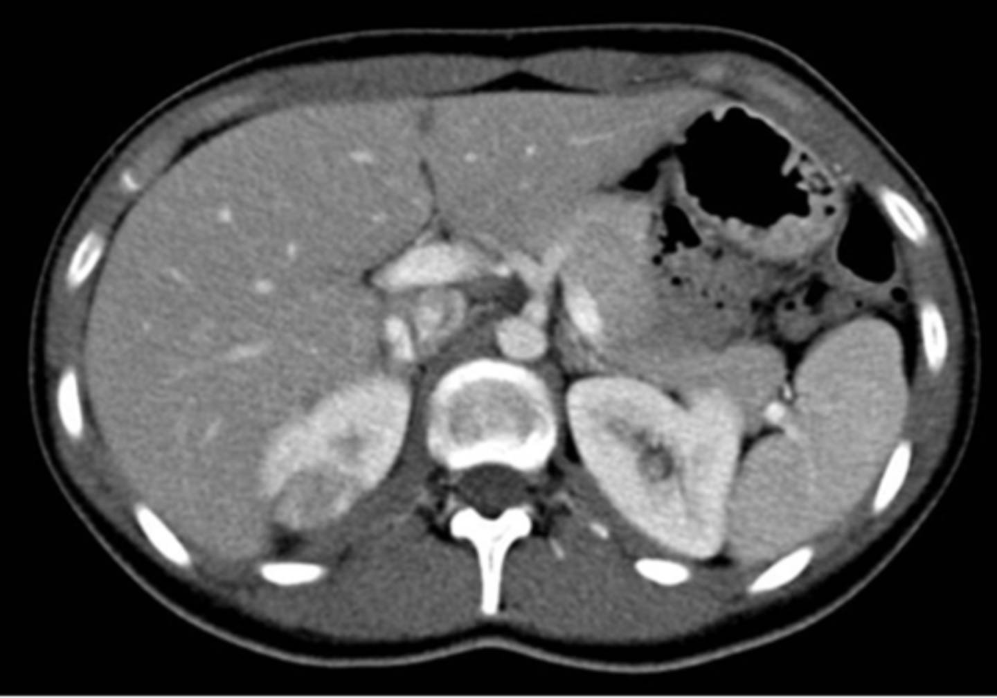 <p>- Pielonefritis → Riñón aumentado de tamaño, con clínica infecciosa.</p><p>- Infarto renal → No hay aumento de tamaño, hay déficit de perfusión.</p>