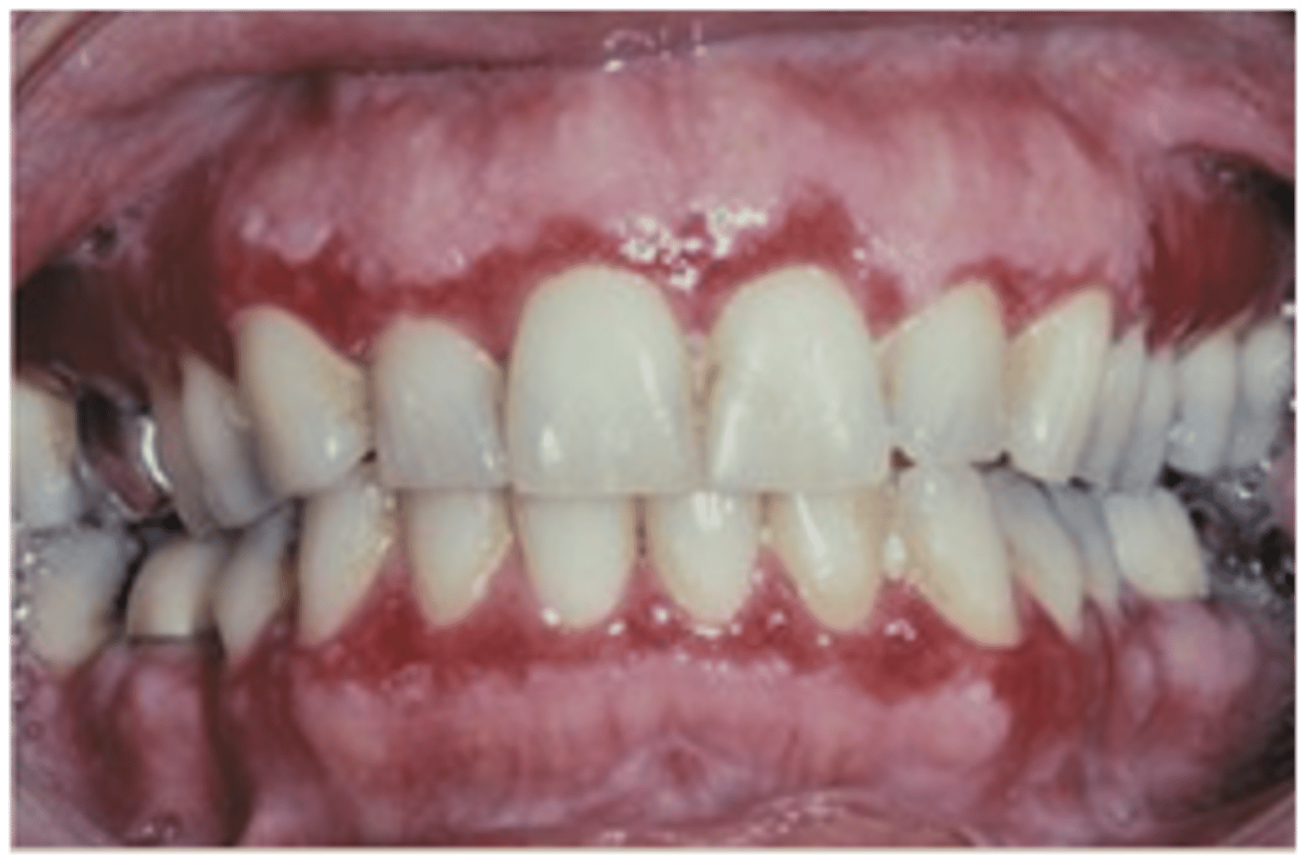 <p>cicatricial pemphigoid</p>