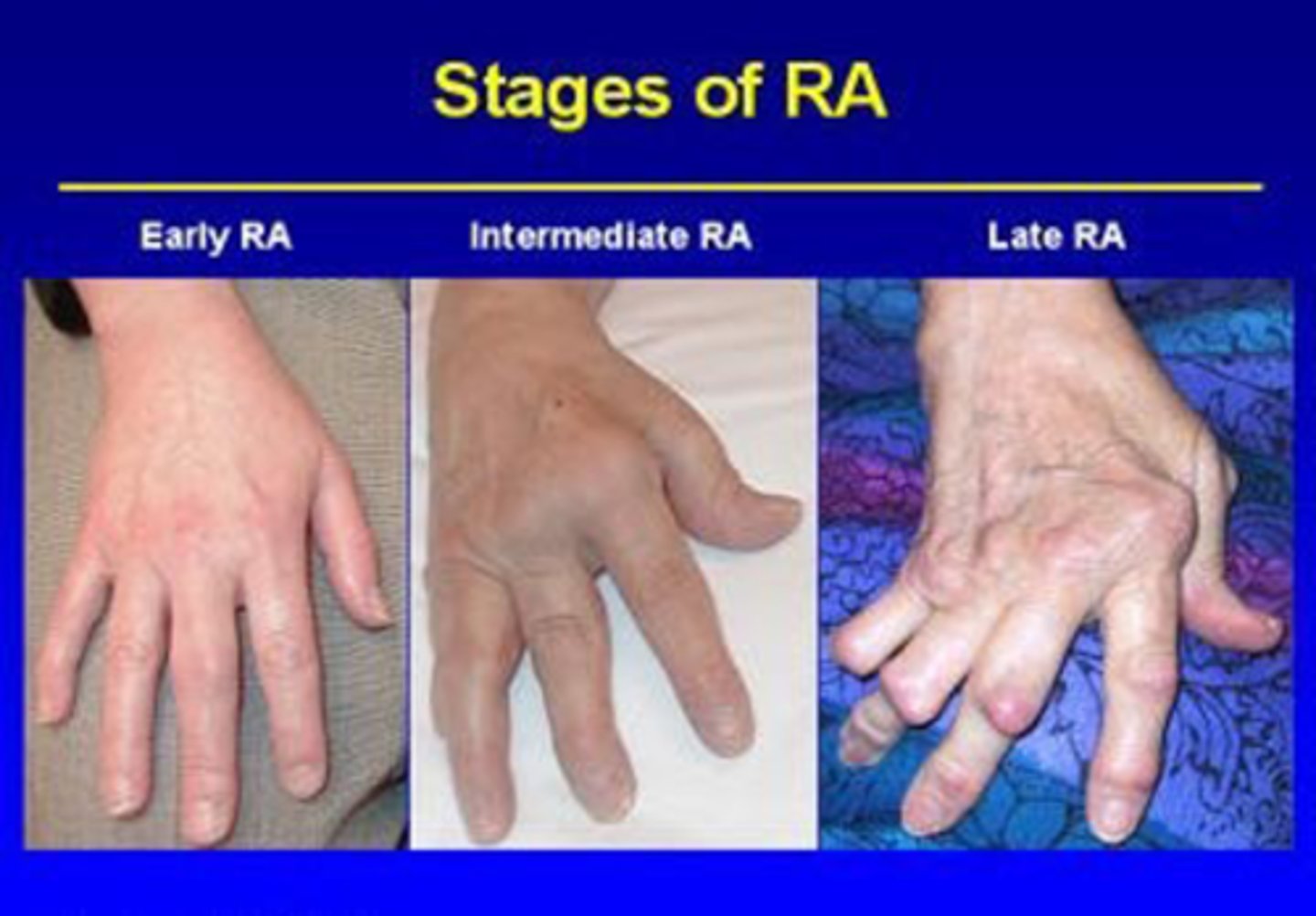<p>it's a progressive disease-deformities caused by disruption/erosion of ligaments and tendons</p><p>Early RA -&gt; Intermediate RA -&gt; Late RA</p>