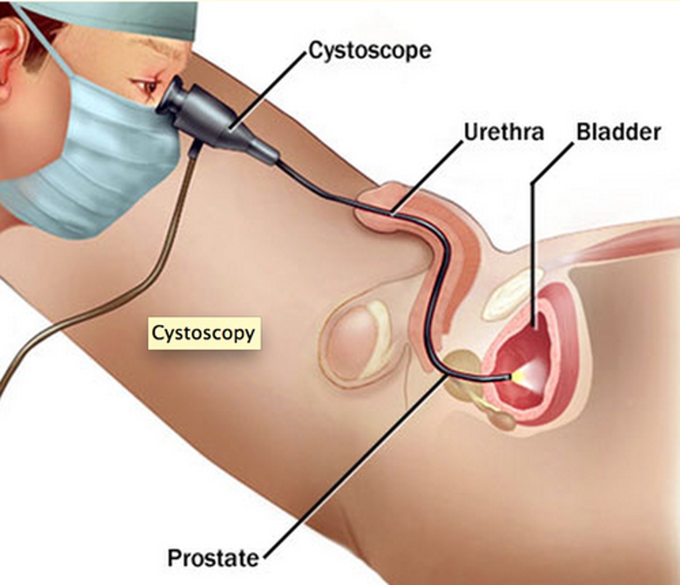 <p>Procedure to locate and control bleeding in the bladder (for hematuria)</p>
