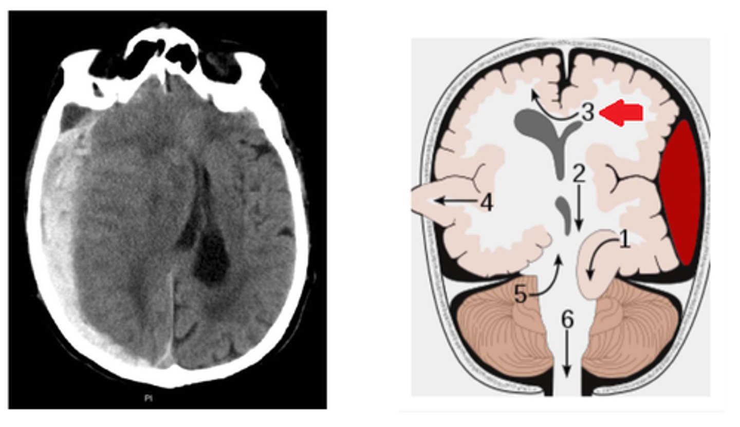<p>Define Brain Herniation:</p><p>Causes Anterior Cerebral Artery Compression --&gt;</p><p>-Contralat leg weakness</p><p>-Aphasia IF dominant hemisphere affected</p>