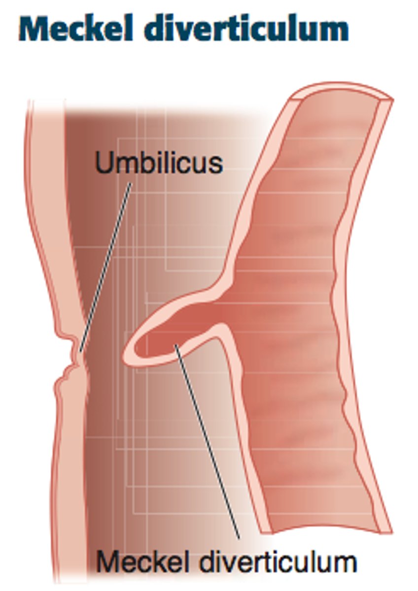 <p>meckel's diverticulum --&gt; get an abdominal CT</p><p>2% of population </p><p>2" in length </p><p>2 yo </p><p>2 types of mucosa </p><p>tx if kid has s/s of bleeding = laparoscopic ileal resection</p>
