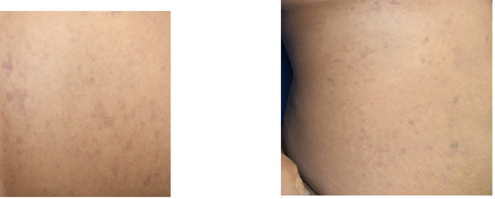 <p>meningeal rash can be indicative of?</p>