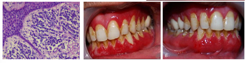 <p>-allergic rxn to various allergens including components of chewing gum, herbal toothpaste, mint candy, peppers used for cooking, etc.</p><p>-rapid onset of sore mouth, intensified by dentrifices and hot/spicy foods</p><p>-entire gingiva becomes diffusely enlarged with bright erythema and loss of normal stippling</p><p>-edentulous areas exhibit less intense change</p><p>-topical placement of allergenic material → localized gingival and vestibular alteration</p>