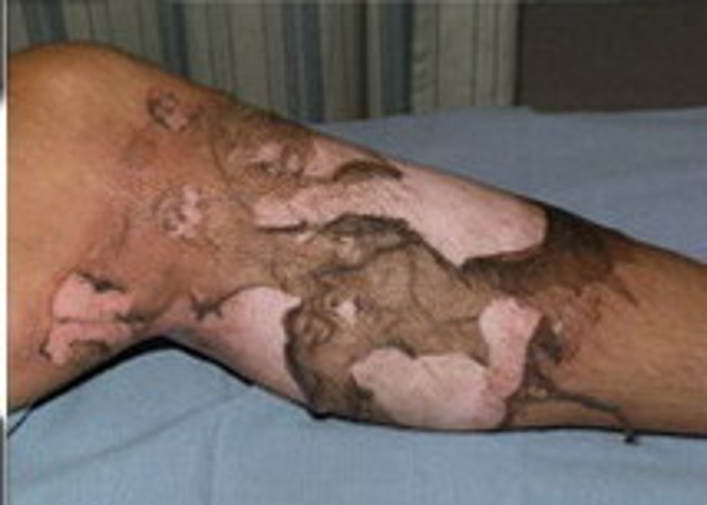 <p>- brown or charred skin</p><p>- tissue underneath appear white</p><p>- may not feel pain</p><p>may be life threatening</p>