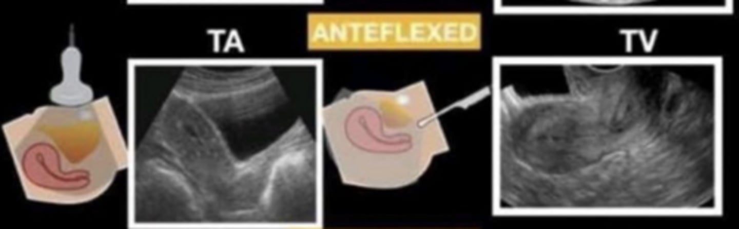 <p>body and fundus only angle anteriorly</p>