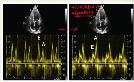 <p>to unmask pseudonormal diastolic dysfunction; </p><p>valsalva decreases preload and causes E/A ratio to be less than 1</p>