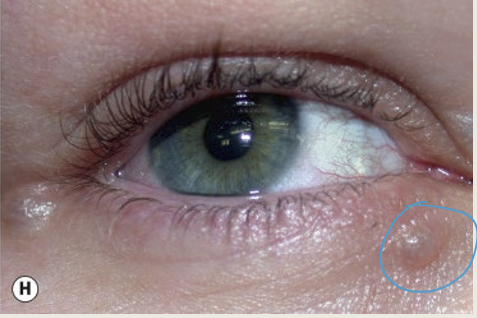 <p>A sweat gland cyst. It appears at the medial or lateral aspect of the lid. It does not directly involve lid margin. The treatment is observation. </p>