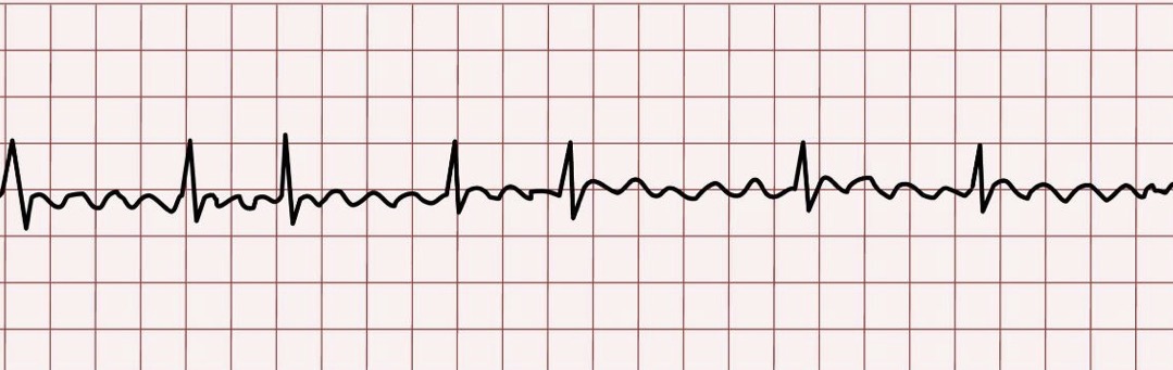 <p>A common type of arrhythmia affecting the heart's rhythm, characterized on ECG by irregularly irregular rhythm, absence of distinct P waves, and presence of fibrillation waves.</p>