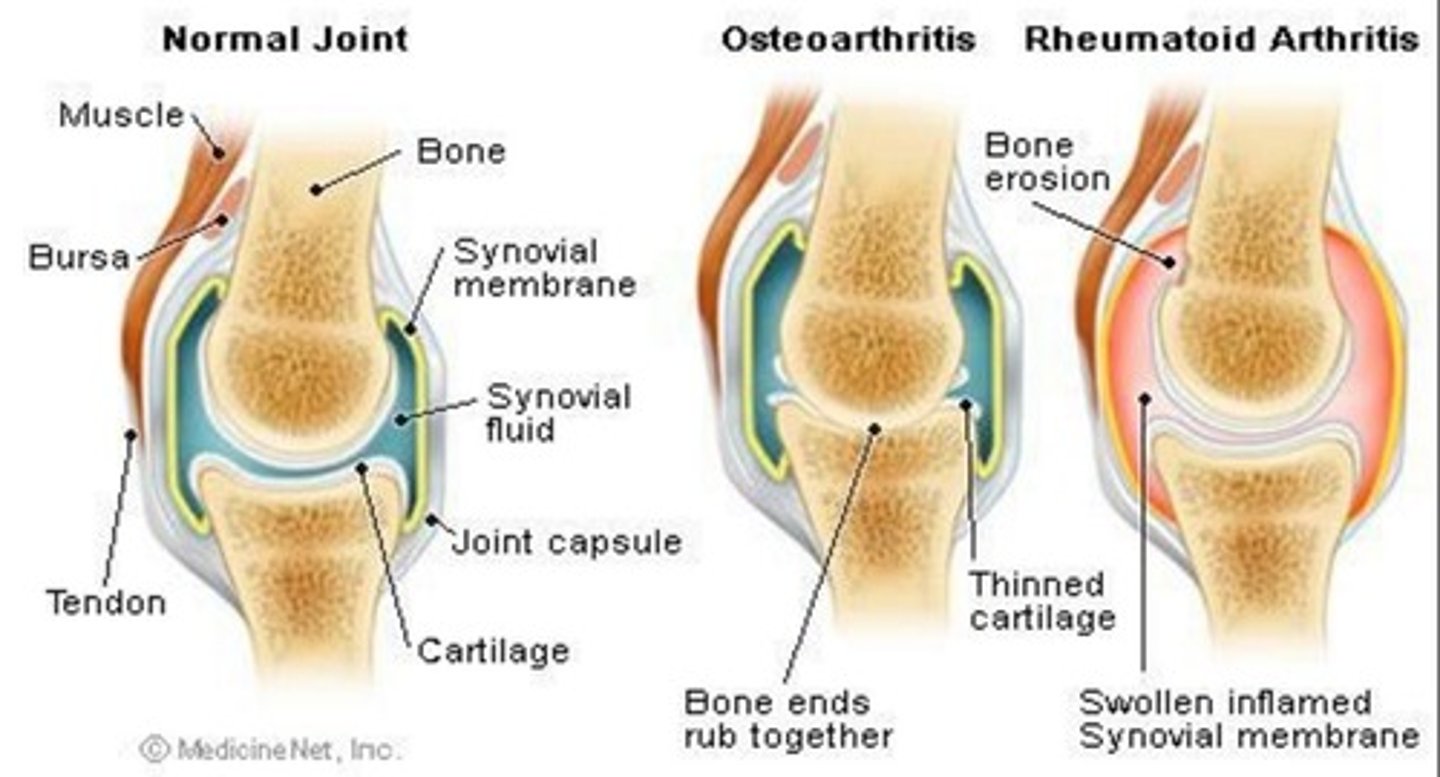<p>- chronic pain</p><p>- progressive physical impairment</p><p>- affects joints, skin, muscles, ligaments, and/or tendons</p>