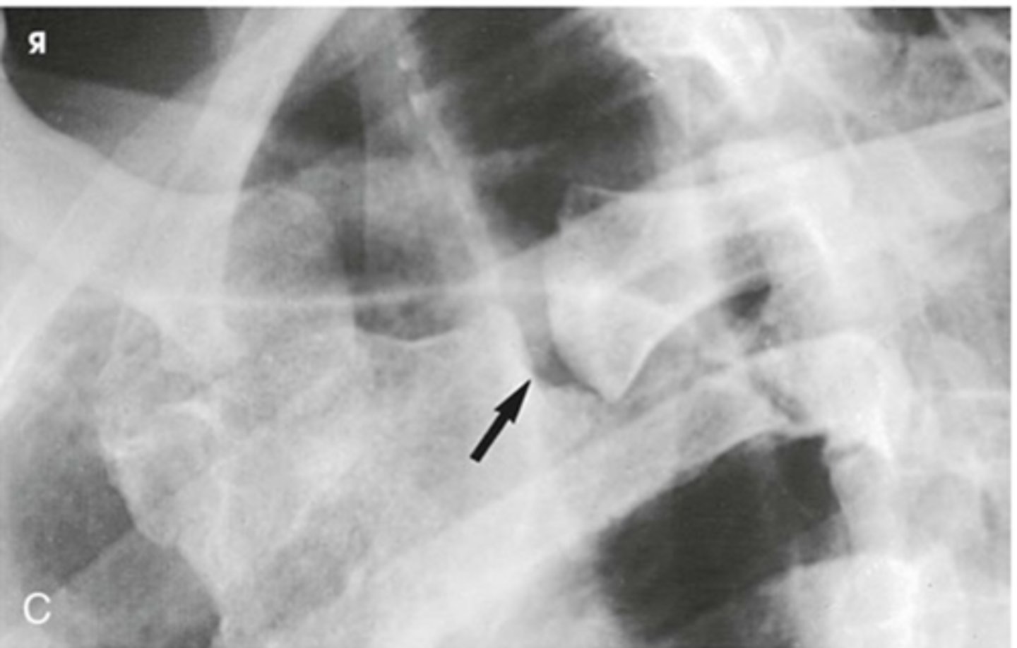 <p>10-15 degree oblique. RAO shows right SC joint, LAO shows left SC joint. Joint of interest will be visible just lateral to the spine.</p>