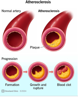 <p><span>the formation of deposits of yellowish plaques that contain cholesterol, lipoid material, and lipophages.</span></p>