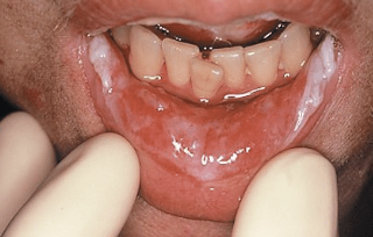 <p>Ulcers with extensive erythema</p><p>Patient CANNOT swallow food, only liquid diet only</p><p>*considered severe mucositis</p>