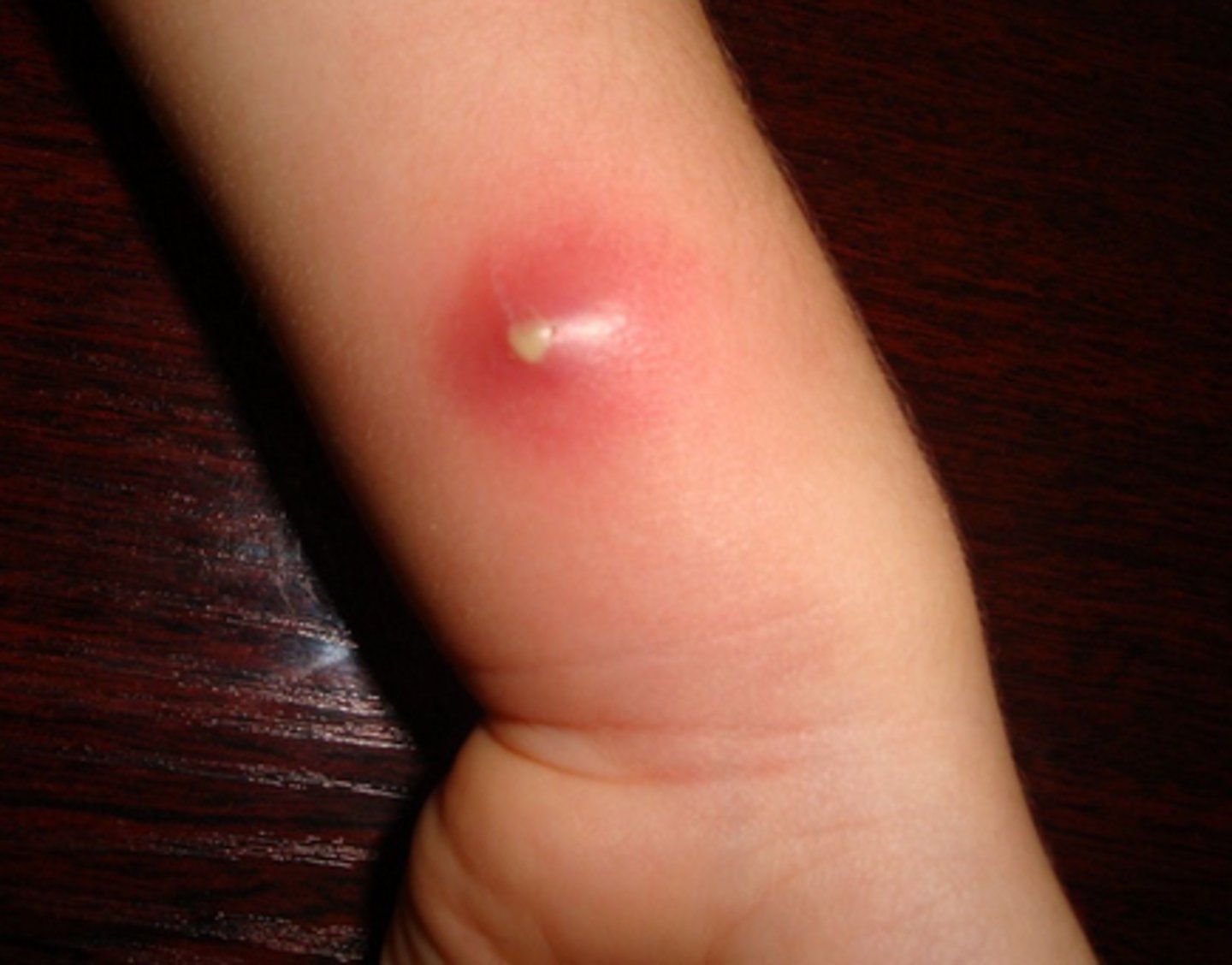 <p>Collection of pus underneath the skin</p>