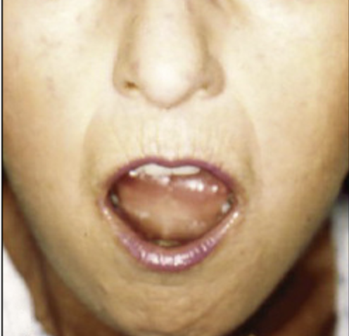 <p>Changes in the Skin of the Face in Scleroderma </p>