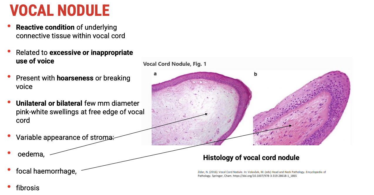 <p><span data-name="mag" data-type="emoji">🔍</span><span><strong>&nbsp;Histology &amp; Pathophysiology</strong></span></p><ul><li><p><span>Vocal nodules are a&nbsp;<strong>reactive lesion of the underlying connective tissue</strong>&nbsp;(stromal layer) of the&nbsp;<strong>true vocal folds</strong>.</span></p></li><li><p><span>They result from&nbsp;<strong>excessive or inappropriate voice use</strong>&nbsp;(voice abuse or misuse).</span></p></li><li><p><span>Histological changes include:</span></p><ul><li><p><span><strong>Edema</strong>&nbsp;(fluid accumulation in the stroma)</span></p></li><li><p><span><strong>Focal haemorrhage</strong>&nbsp;(small bleeding spots)</span></p></li><li><p><span><strong>Fibrosis</strong>&nbsp;(scarring and thickening of connective tissue)</span></p></li></ul></li><li><p><span>Nodules&nbsp;<strong>do not involve malignant transformation</strong>&nbsp;or epithelial dysplasia—there is&nbsp;<strong>no cancer risk</strong>.</span></p></li></ul><p>&nbsp;</p><p><span data-name="eye" data-type="emoji">👁</span><span><strong>&nbsp;Macroscopic Appearance (Laryngoscopy)</strong></span></p><ul><li><p><span>Small,&nbsp;<strong>pink-white swellings</strong>&nbsp;located at the&nbsp;<strong>free edge</strong>&nbsp;of the vocal folds.</span></p></li><li><p><span>Can be:</span></p><ul><li><p><span><strong>Unilateral or bilateral</strong></span></p></li><li><p><span><strong>Bilateral nodules</strong>&nbsp;may create an&nbsp;<strong>hourglass shape</strong>&nbsp;of the glottis during phonation.</span></p></li></ul></li></ul><p>&nbsp;</p><p><span data-name="speaking_head" data-type="emoji">🗣</span><span><strong>&nbsp;Clinical Presentation</strong></span></p><ul><li><p><span>Common symptoms include:</span></p><ul><li><p><span><strong>Hoarseness</strong></span></p></li><li><p><span><strong>Voice breaks or instability</strong></span></p></li><li><p><span>Vocal fatigue</span></p></li></ul></li></ul><p>&nbsp;</p><p><span data-name="brain" data-type="emoji">🧠</span><span><strong>&nbsp;Summary</strong></span></p><table style="min-width: 50px"><colgroup><col style="min-width: 25px"><col style="min-width: 25px"></colgroup><tbody><tr><td colspan="1" rowspan="1" style="border-width:0pt;vertical-align:top;width:1.7694in;padding:4pt 4pt 4pt 4pt"><p><span><strong>Feature</strong></span></p></td><td colspan="1" rowspan="1" style="border-width:0pt;vertical-align:top;width:3.6576in;padding:4pt 4pt 4pt 4pt"><p><span><strong>Description</strong></span></p></td></tr><tr><td colspan="1" rowspan="1" style="border-width:0pt;vertical-align:top;width:1.7694in;padding:4pt 4pt 4pt 4pt"><p>Cause</p></td><td colspan="1" rowspan="1" style="border-width:0pt;vertical-align:top;width:3.6576in;padding:4pt 4pt 4pt 4pt"><p>Excessive/inappropriate voice use</p></td></tr><tr><td colspan="1" rowspan="1" style="border-width:0pt;vertical-align:top;width:1.7694in;padding:4pt 4pt 4pt 4pt"><p>Histology</p></td><td colspan="1" rowspan="1" style="border-width:0pt;vertical-align:top;width:3.727in;padding:4pt 4pt 4pt 4pt"><p>Reactive stromal changes (edema, haemorrhage, fibrosis)</p></td></tr><tr><td colspan="1" rowspan="1" style="border-width:0pt;vertical-align:top;width:1.7888in;padding:4pt 4pt 4pt 4pt"><p>Macroscopic Appearance</p></td><td colspan="1" rowspan="1" style="border-width:0pt;vertical-align:top;width:3.6381in;padding:4pt 4pt 4pt 4pt"><p>Small pink-white nodules at free vocal fold edge</p></td></tr><tr><td colspan="1" rowspan="1" style="border-width:0pt;vertical-align:top;width:1.7694in;padding:4pt 4pt 4pt 4pt"><p>Malignancy Risk</p></td><td colspan="1" rowspan="1" style="border-width:0pt;vertical-align:top;width:3.6576in;padding:4pt 4pt 4pt 4pt"><p>None</p></td></tr><tr><td colspan="1" rowspan="1" style="border-width:0pt;vertical-align:top;width:1.7694in;padding:4pt 4pt 4pt 4pt"><p>Symptoms</p></td><td colspan="1" rowspan="1" style="border-width:0pt;vertical-align:top;width:3.6576in;padding:4pt 4pt 4pt 4pt"><p>Hoarseness, voice breaks, vocal fatigue</p></td></tr></tbody></table><p></p>
