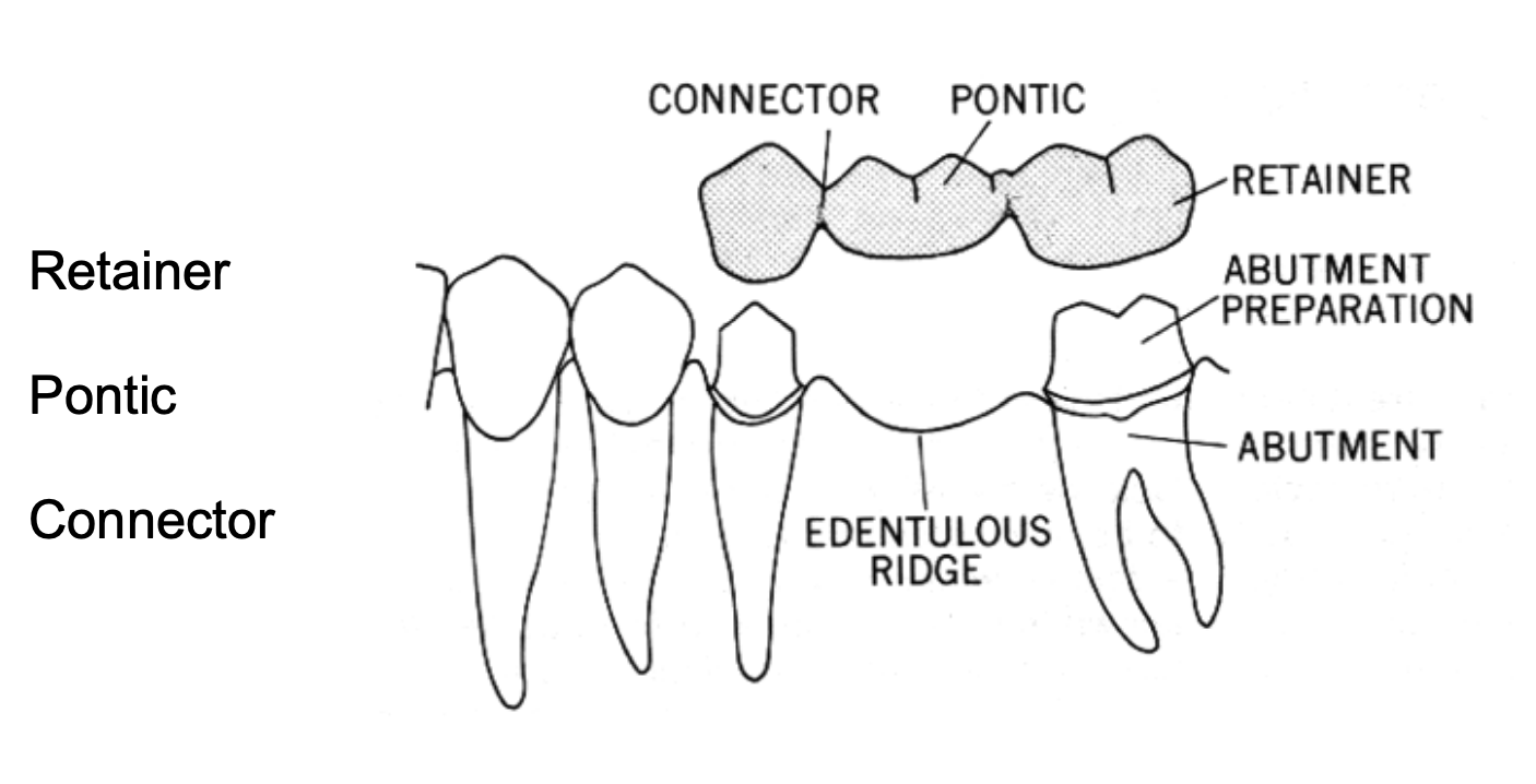 <p>an artificial tooth on a fixed dental prosthesis that replaces a missing natural tooth, restores its funx, and usually fills the space previously occupied by the clinical crown </p>