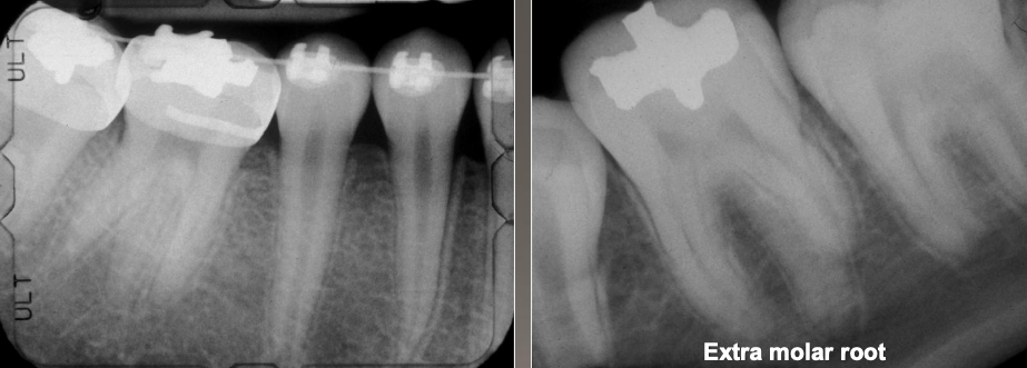 <p>Increased number of roots</p><p>Both deciduous and permanent</p><p>Most affected: <strong>mand 3rd molars</strong> &gt; cuspids and bicuspids</p><p>No treatment but detection is important if endo treatment is needed</p>