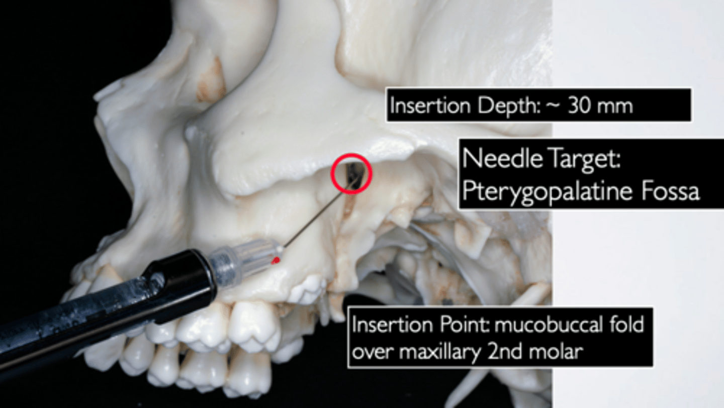 <p>ID the anesthesia technique:</p>