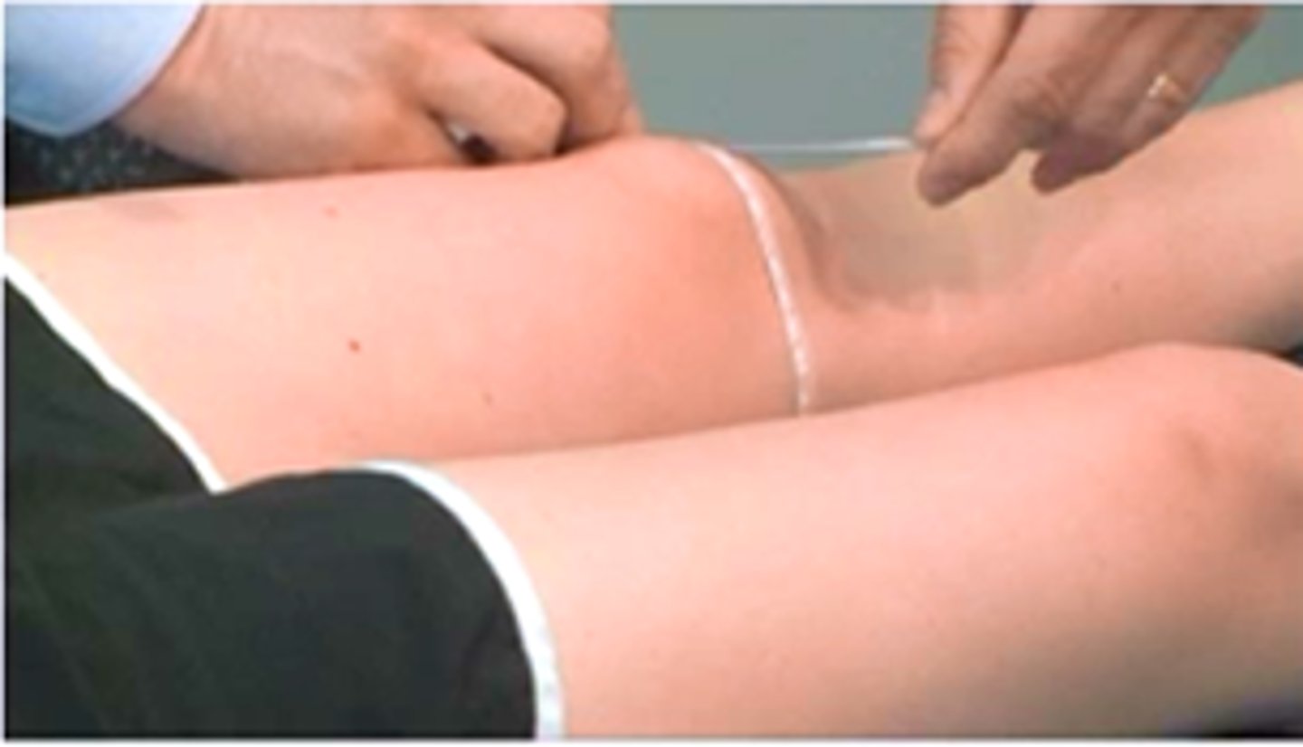 <p>use skin pencil to mark and then take circumference of limb at various points up extremity</p>