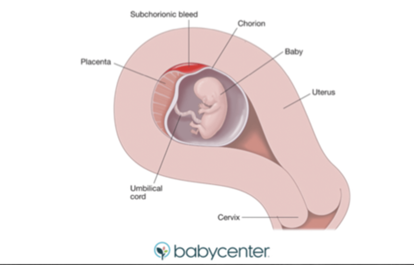 <p>bleeding between uterine wall and chorion</p><p>- may be asymptomatic or w/ light bleeding</p><p>- associated w/ increased miscarriage risk</p>