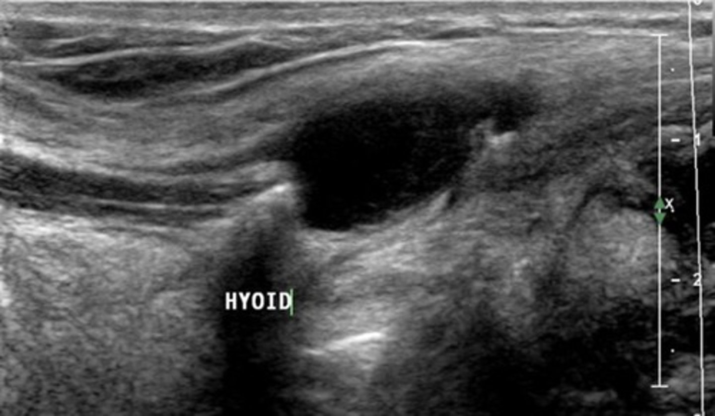 <p>Remnant of thyroglossal duct</p><p>More common in children</p>