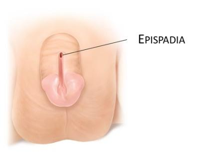 <p>uitmonding van de urethra op de dorsale zijde van de penis </p>