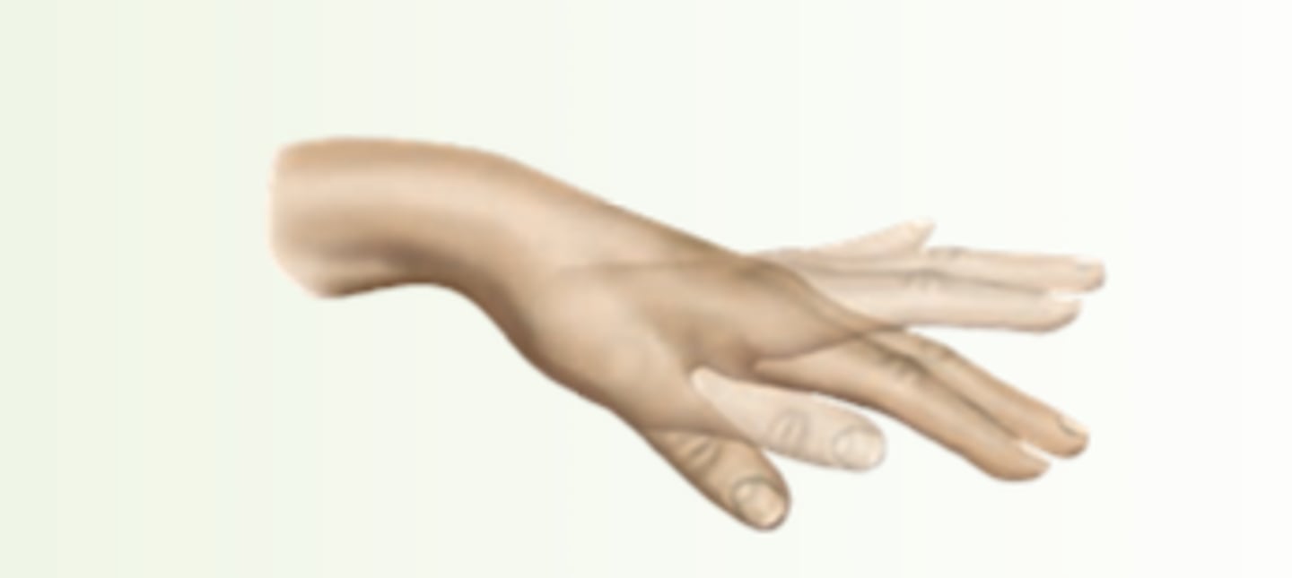 <p>are brief, rapid, jerky, irregular, and unpredictable. They occur at rest or interrupt normal coordinated movements. Unlike tics, they seldom repeat themselves. The face, head, lower arms, and hands are often involved. Causes include Sydenham chorea (with rheumatic fever) and Huntington disease.</p>