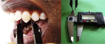 <p>What is this index = Length of canine teeth / Length of incisors x 10</p>