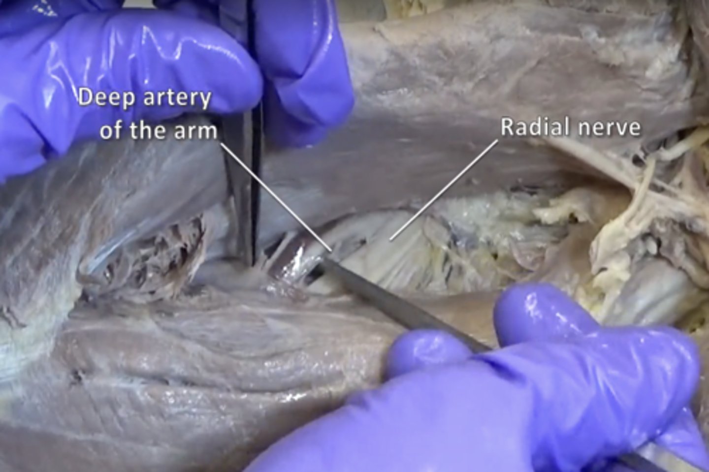 <p>Runs the posterior course of the humerus, is "Deep" between the triceps brachii</p>