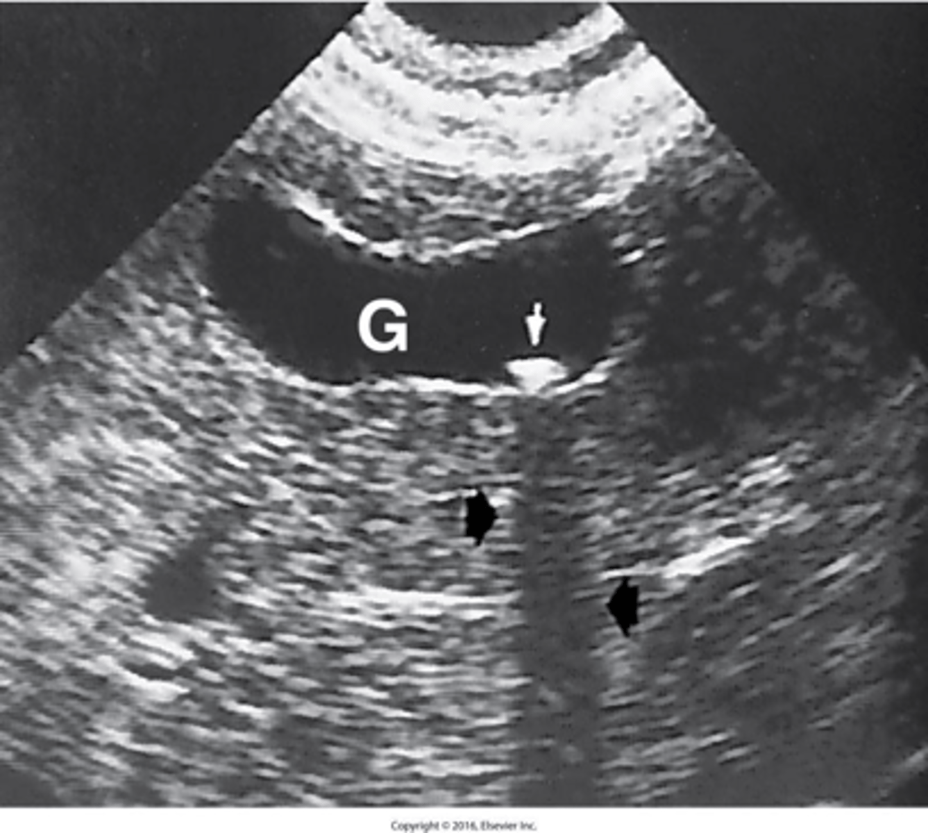 <p>Describe Gallstones (Cholelithiasis):</p>