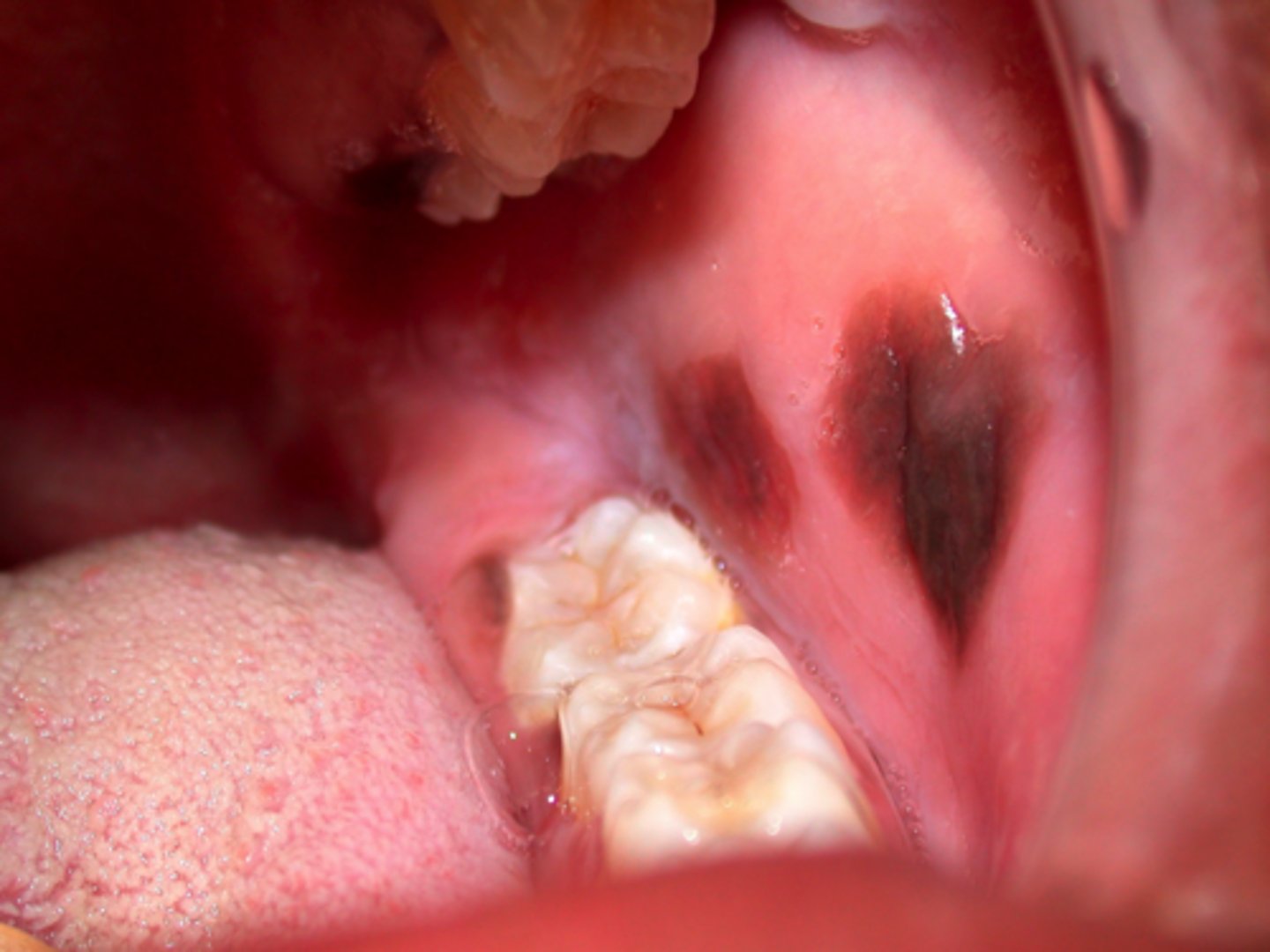 <p>treatment for which type of pigmented lesion:</p><p>• Biopsy to rule out melanoma</p><p>• Once diagnosis is established, no</p><p>treatment is necessary</p><p>• Lesions fade over time</p><p>• No malignant potential</p>