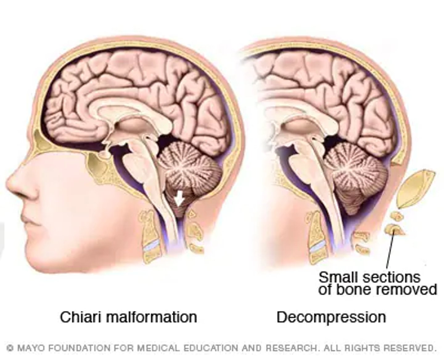 <p>Craniectomy, takes care of the syrinxes but leaves a soft spot that needs protection with helmets</p>