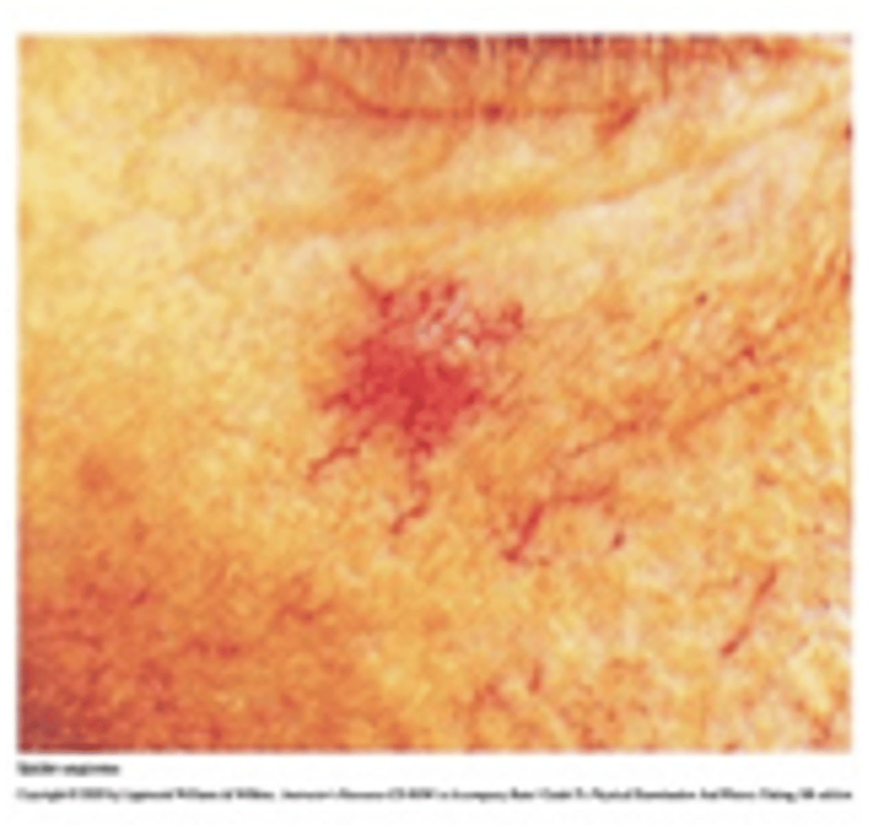 <p>Central red macule with radiating spider-like arms</p>