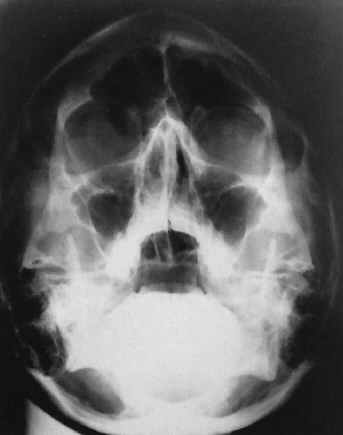 <p>What is this x-ray demonstrating?</p>