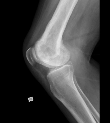 <p>Formation of many layers of thick periosteum seen in Paget’s disease</p>