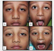 <ul><li><p><span>Def: A neurogenic condition characterized by eyelid movement in response to jaw movement.</span></p></li><li><p><span>Caused by congenital aberrant connections between the trigeminal nerve and oculomotor nerve which controls the levator palpebrae superioris</span></p></li><li><p><span>Usually unilateral, can be bilateral</span></p></li><li><p><span>Unlike simple congential ptosis, amblyopia risk rarely due to ptosis; Anisometropia is due to irregular astigmatism</span></p></li></ul><p></p>