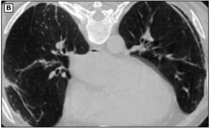 <p>What are you going to see on a chest CT positive for asbestosis?</p>