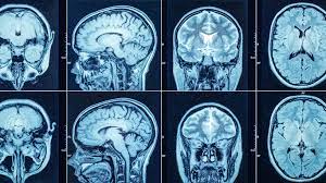 X-ray projections acquired at multiple view angles. Cross-sectional images reconstructed.

Image contrast depends on DENSITY of tissue