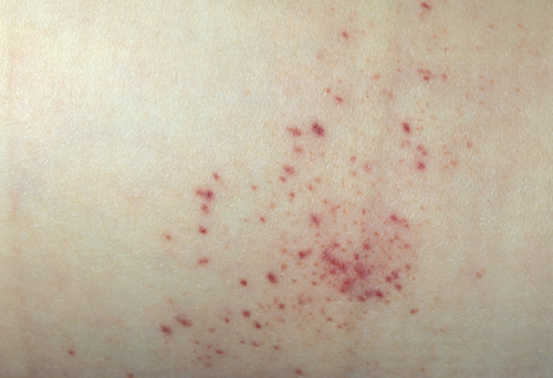 <p>tiny purple or red spot caused by bleeding into the skin</p>