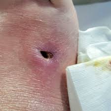 <p><span>Death of tissue. Necrosis may be seen in INFLAMMATION, as well as in NEOPLASMS.</span></p>