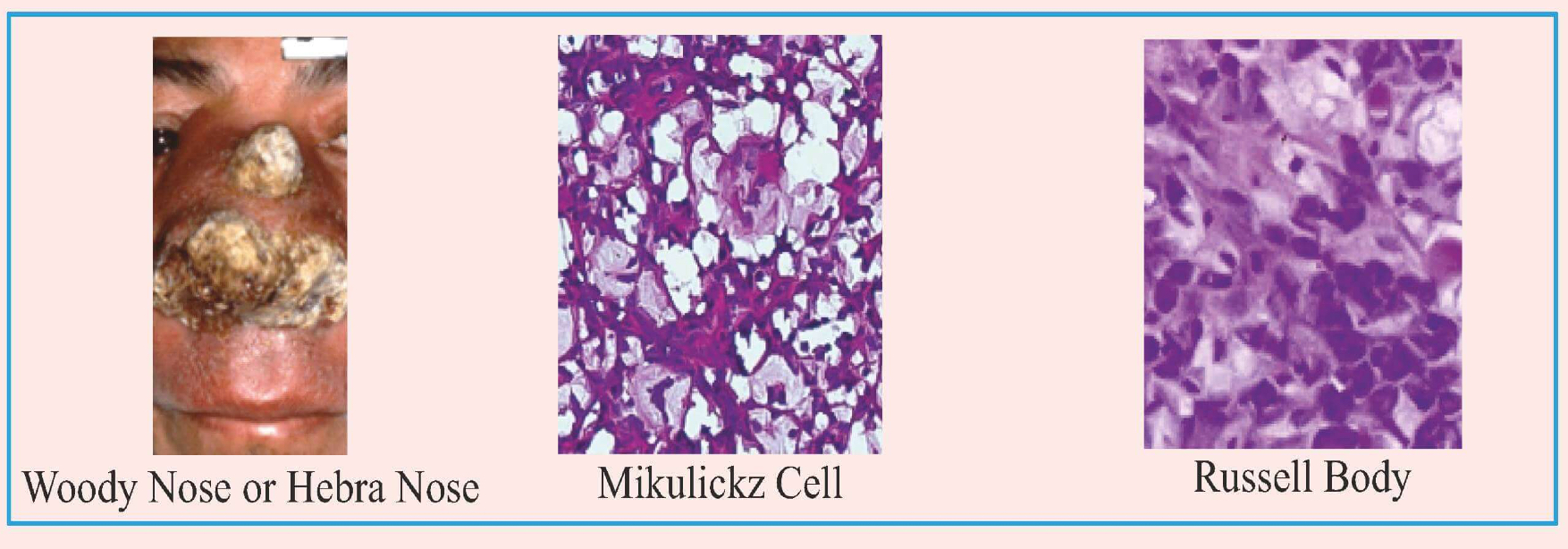 <p> Gross findings</p><ul><li><p>• Woody nose or hebra nose</p></li></ul><p>• Microscopic findings</p><ul><li><p>• Mikulickz cell → Foamy cell</p></li><li><p>• Russell body → Immunoglobulin production</p></li></ul>