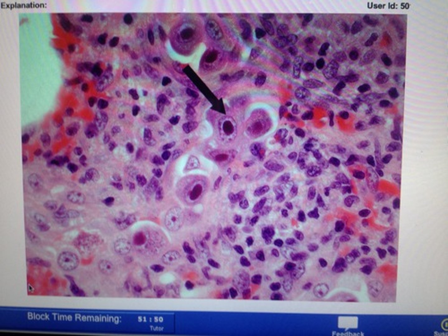 <p>interstitial PNA in transplant Pt.</p>
