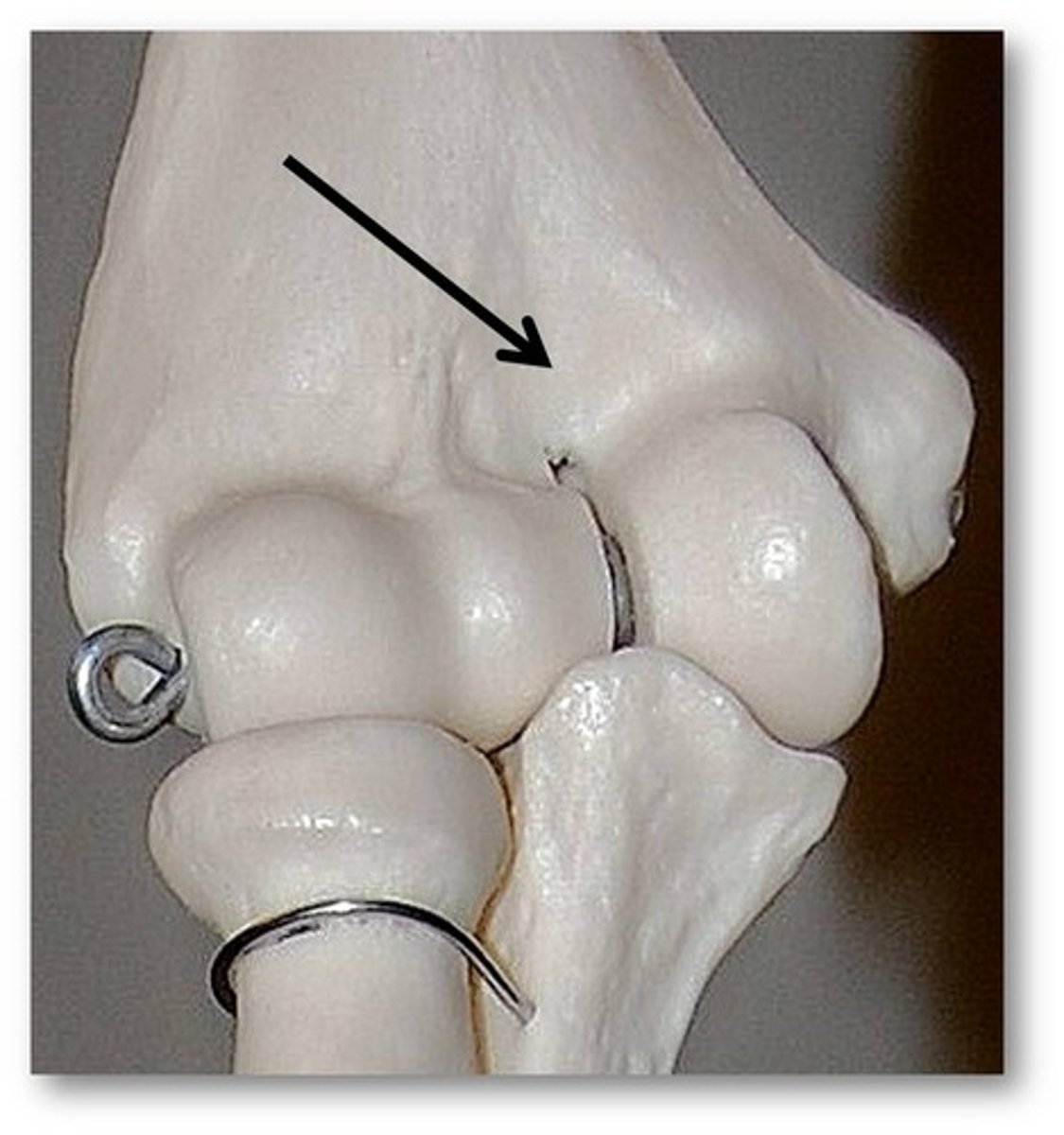 <p>Name this specific part of the humerus.</p>