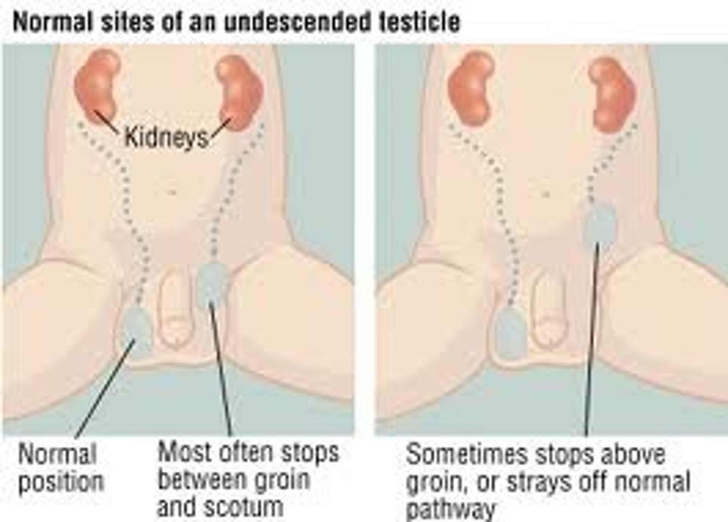 <p>state of hidden testes. (During fetal development, testes are located in the abdominal area near the kidneys. Before birth they move down into the scrotal sac. Failure of the testes to descend from the abdominal cavity into the scrotum before birth results in cryptorchidism) (also called undescended testicle and undescended testicles)</p>