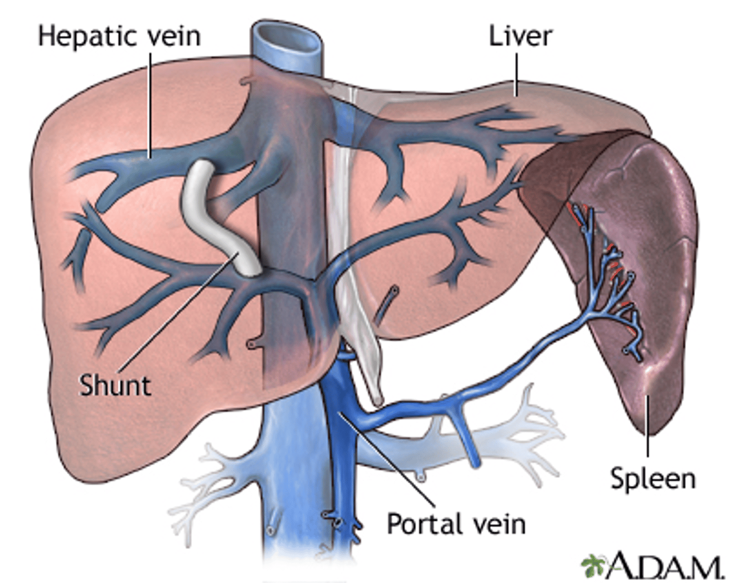 <p>TIPS (Transvenous Intrahepatic Portosystemic Shunt)</p>