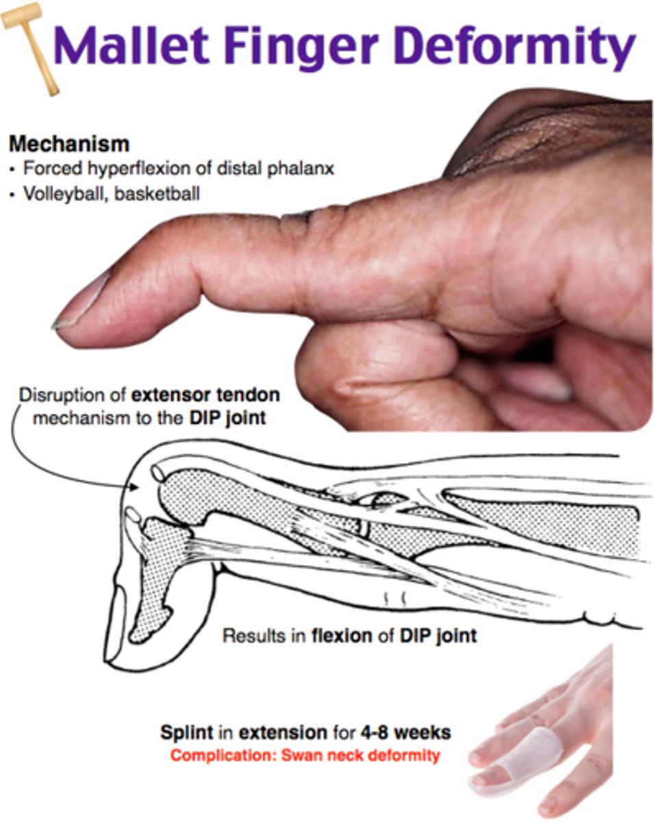 <p>DIP flexion (and PIP extension)</p><p>occurs bc of rupture of extensor tendon as it crosses the DIP joint</p><p>the finger loses the ability to extend the distal phalanx</p>