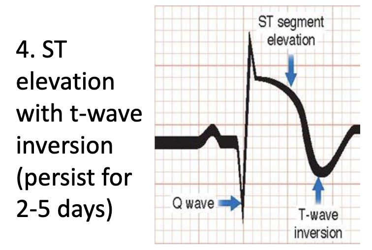 <p>ST elevation with t-wave inversion (persist for 2-5 days)</p>
