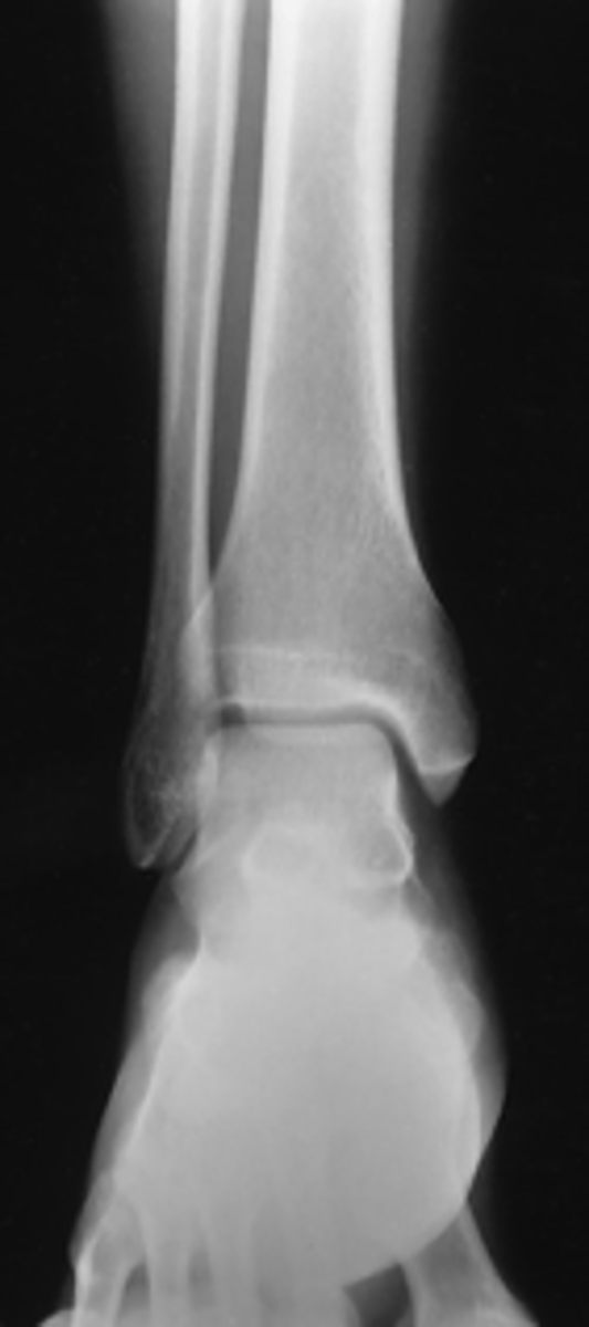 <p>- AP</p><p>- CR midway between malleoli</p><p>- Distal ⅓ of tibia and fibula demonstrated</p><p>- Proximal ½ of metatarsals included</p><p>- Medial and superior aspect of ankle joint open</p>